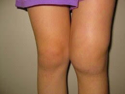 Carmen durante la enfermedad